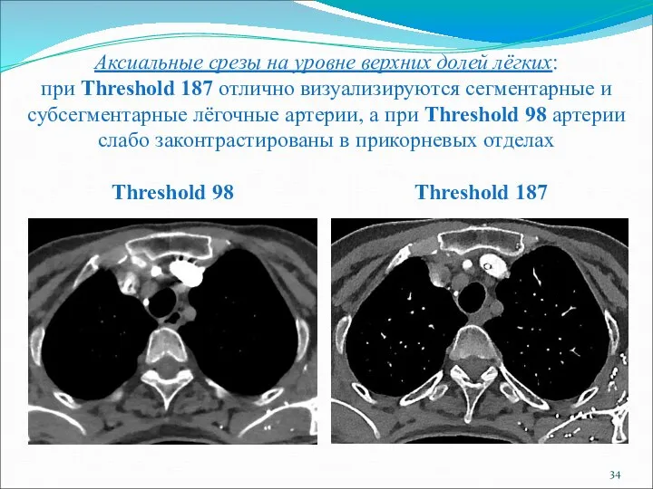 Аксиальные срезы на уровне верхних долей лёгких: при Threshold 187 отлично