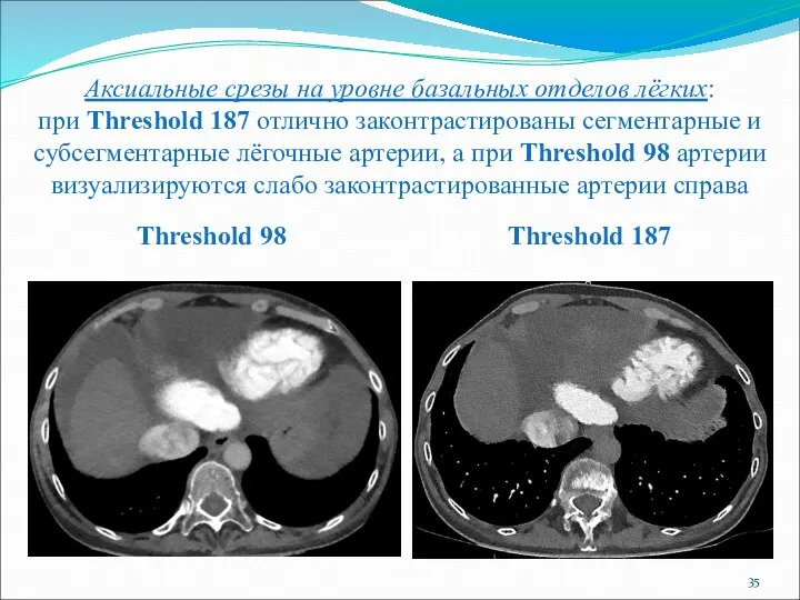 Аксиальные срезы на уровне базальных отделов лёгких: при Threshold 187 отлично