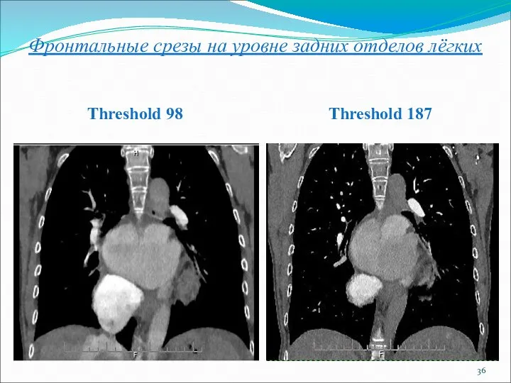 Фронтальные срезы на уровне задних отделов лёгких Threshold 98 Threshold 187