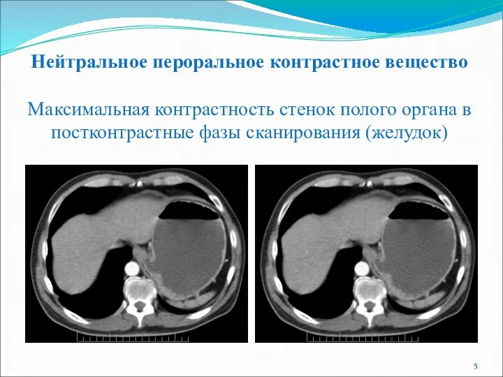 Нейтральное пероральное контрастное вещество Максимальная контрастность стенок полого органа в постконтрастные фазы сканирования (желудок)
