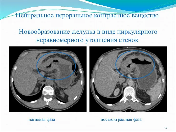 Нейтральное пероральное контрастное вещество Новообразование желудка в виде циркулярного неравномерного утолщения стенок нативная фаза постконтрастная фаза