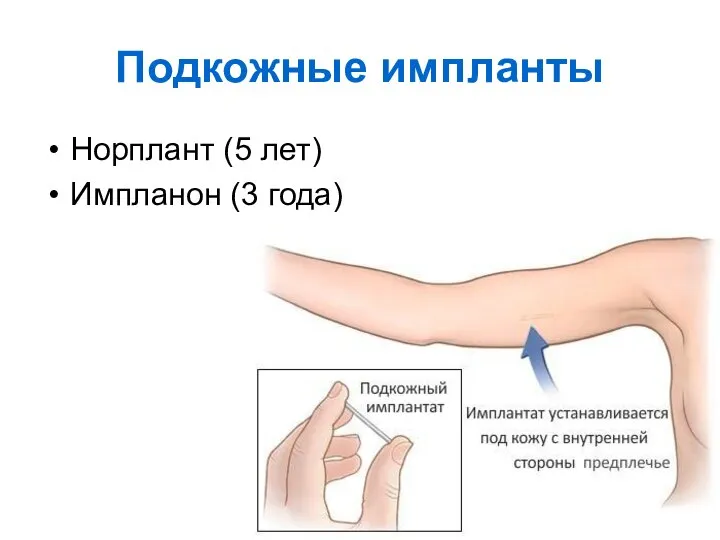 Подкожные импланты Норплант (5 лет) Импланон (3 года)