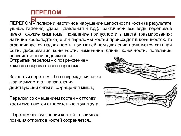 ПЕРЕЛОМЫ ПЕРЕЛОМ – полное и частичное нарушение целостности кости (в результате