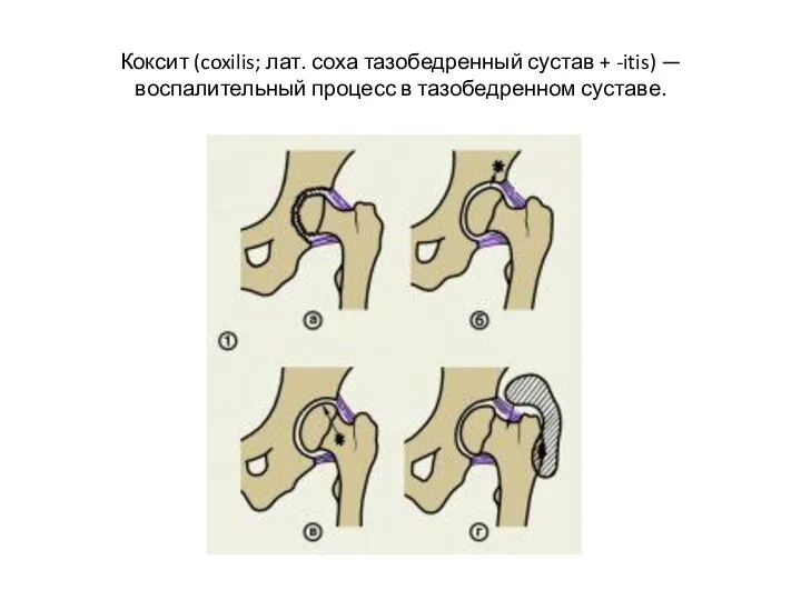 Коксит (coxilis; лат. соха тазобедренный сустав + -itis) — воспалительный процесс в тазобедренном суставе.