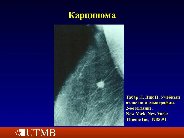 Карцинома Табар Л, Дин П. Учебный атлас по маммографии. 2-ое издание.