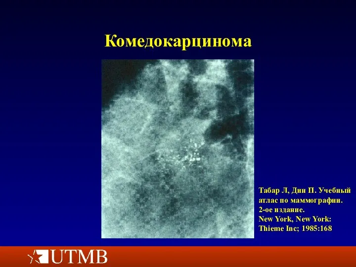 Комедокарцинома Табар Л, Дин П. Учебный атлас по маммографии. 2-ое издание.