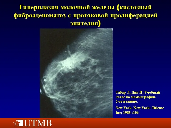 Гиперплазия молочной железы (кистозный фиброаденоматоз с протоковой пролиферацией эпителия) Табар Л,
