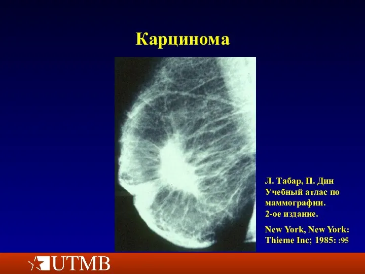Карцинома Л. Табар, П. Дин Учебный атлас по маммографии. 2-ое издание.