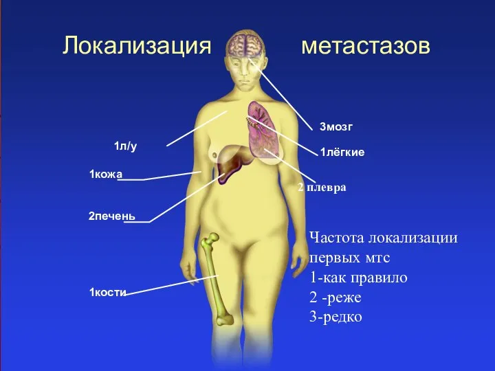 Локализация метастазов 1кожа 2печень 1кости 3мозг 1лёгкие 1л/у 2 плевра Частота