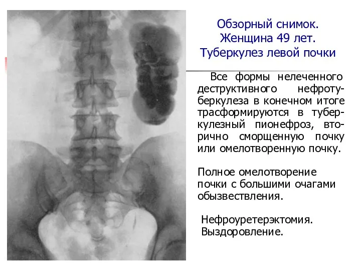 Обзорный снимок. Женщина 49 лет. Туберкулез левой почки Все формы нелеченного