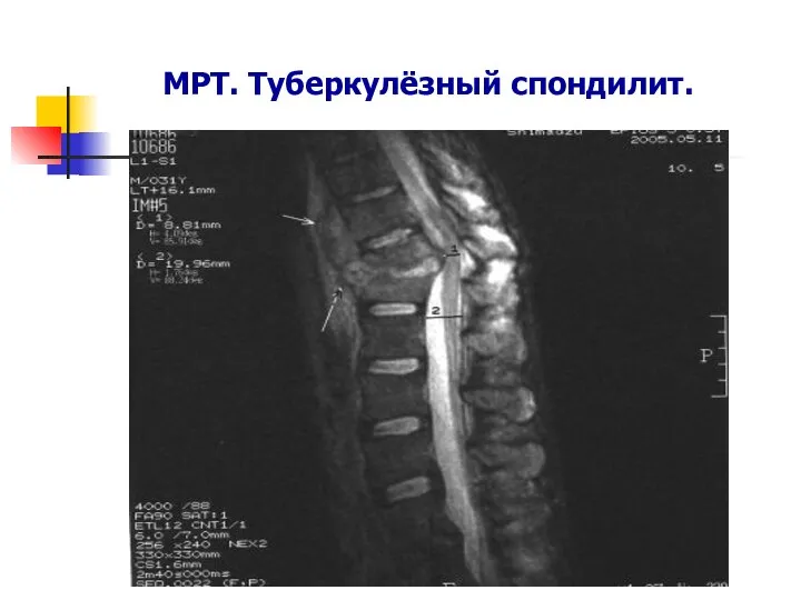 МРТ. Туберкулёзный спондилит.