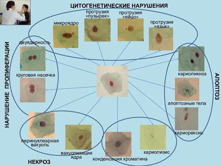 НАРУШЕНИЕ ПРОЛИФЕРАЦИИ ЦИТОГЕНЕТИЧЕСКИЕ НАРУШЕНИЯ АПОПТОЗ НЕКРОЗ микроядро протрузия «пузырек» протрузия «яйцо»