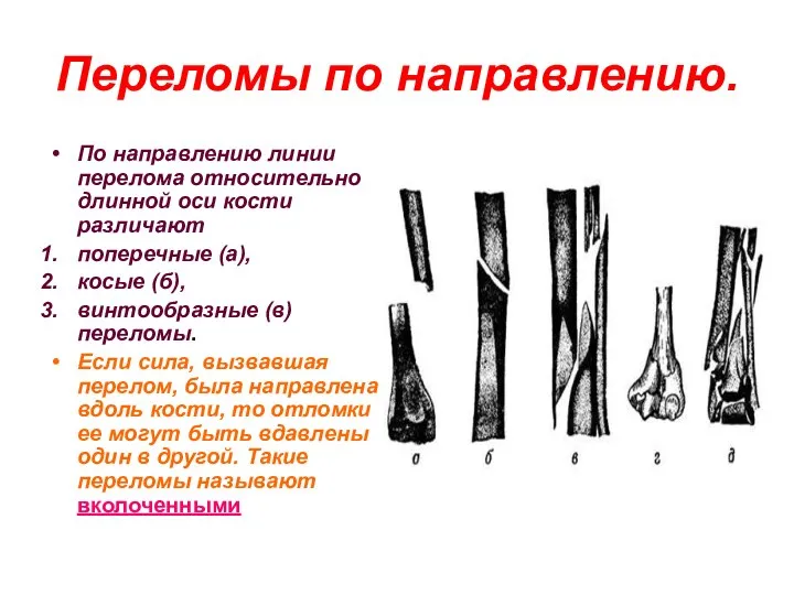 Переломы по направлению. По направлению линии перелома относительно длинной оси кости