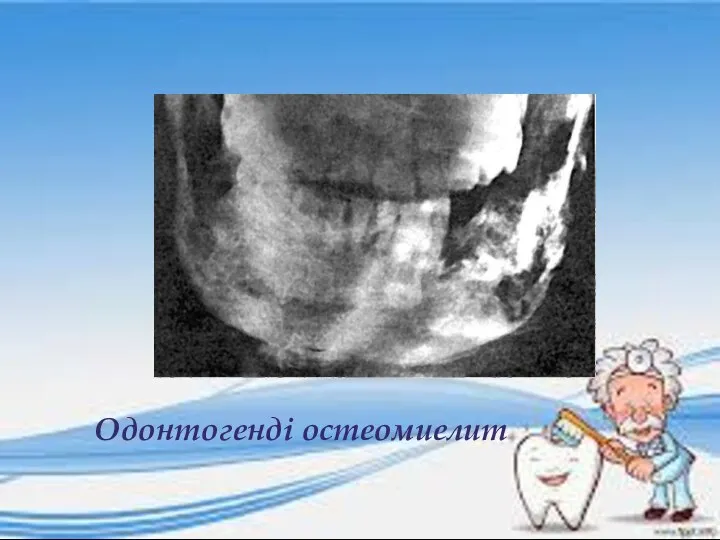 Одонтогенді остеомиелит