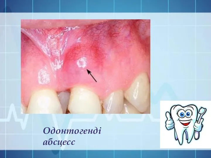 Одонтогенді абсцесс