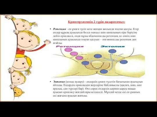 Крипторхизмнің 2 түрін ажыратамыз: Ретенция - ен ұмаға түсіп келе жатқан