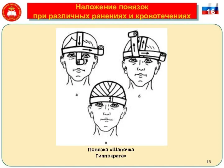 Наложение повязок при различных ранениях и кровотечениях 16 Повязка «Шапочка Гиппократа»