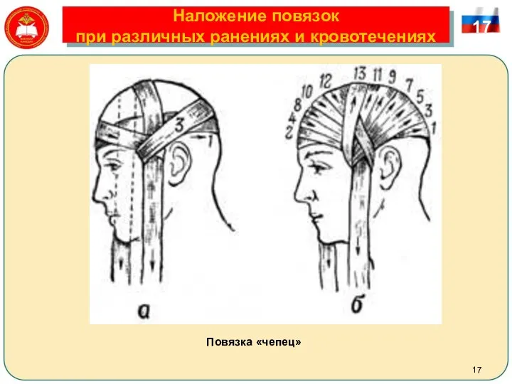 Наложение повязок при различных ранениях и кровотечениях 17 Повязка «чепец»