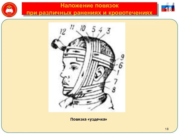 Наложение повязок при различных ранениях и кровотечениях 18 Повязка «уздечка»