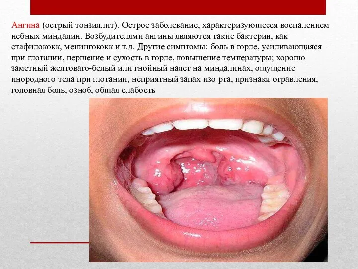 Ангина (острый тонзиллит). Острое заболевание, характеризующееся воспалением небных миндалин. Возбудителями ангины