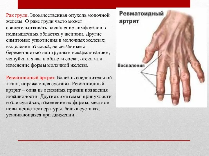 Рак груди. Злокачественная опухоль молочной железы. О раке груди часто может