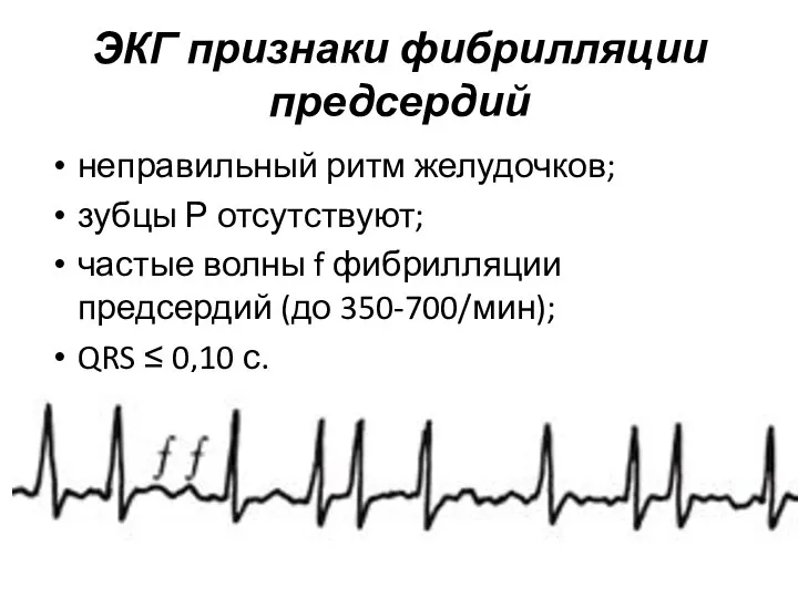 ЭКГ признаки фибрилляции предсердий неправильный ритм желудочков; зубцы Р отсутствуют; частые