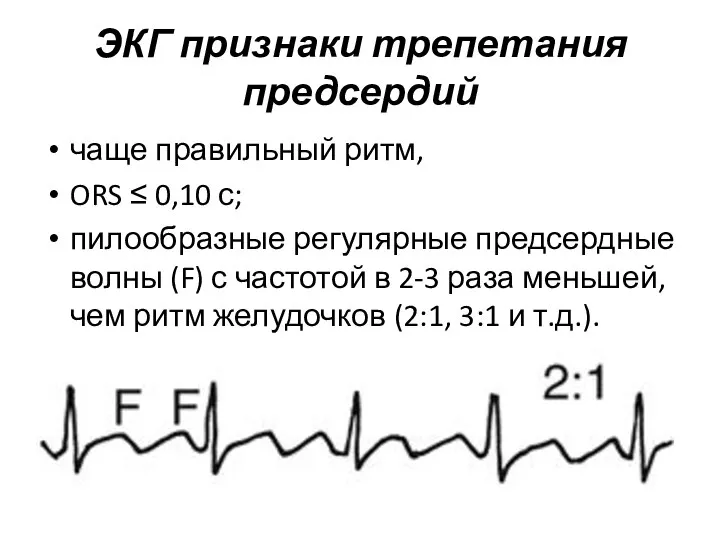 ЭКГ признаки трепетания предсердий чаще правильный ритм, ORS ≤ 0,10 с;