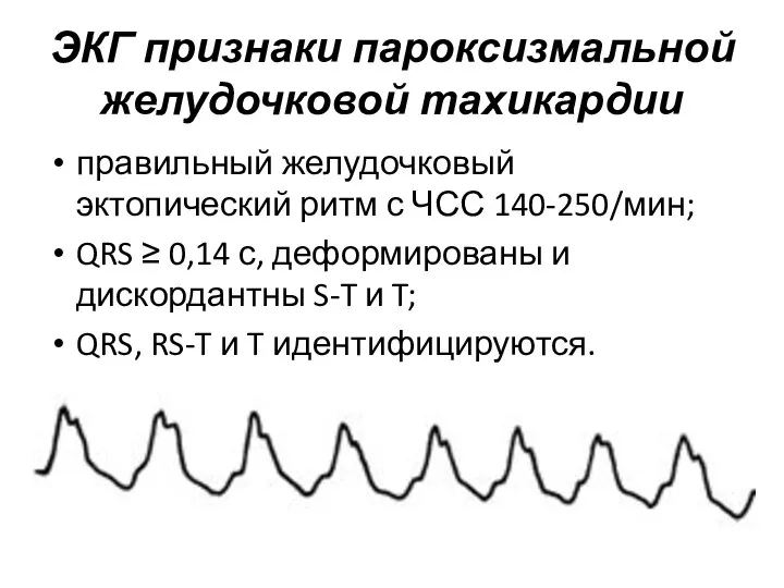 ЭКГ признаки пароксизмальной желудочковой тахикардии правильный желудочковый эктопический ритм с ЧСС