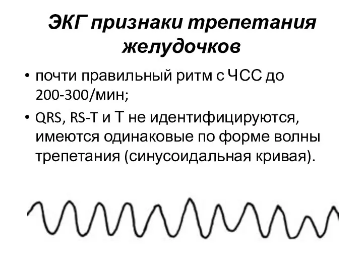 ЭКГ признаки трепетания желудочков почти правильный ритм с ЧСС до 200-300/мин;