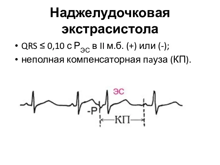 Наджелудочковая экстрасистола QRS ≤ 0,10 с РЭС в II м.б. (+)