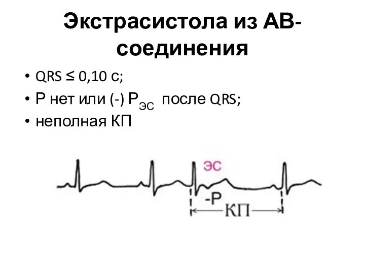 Экстрасистола из АВ-соединения QRS ≤ 0,10 с; Р нет или (-) РЭС после QRS; неполная КП