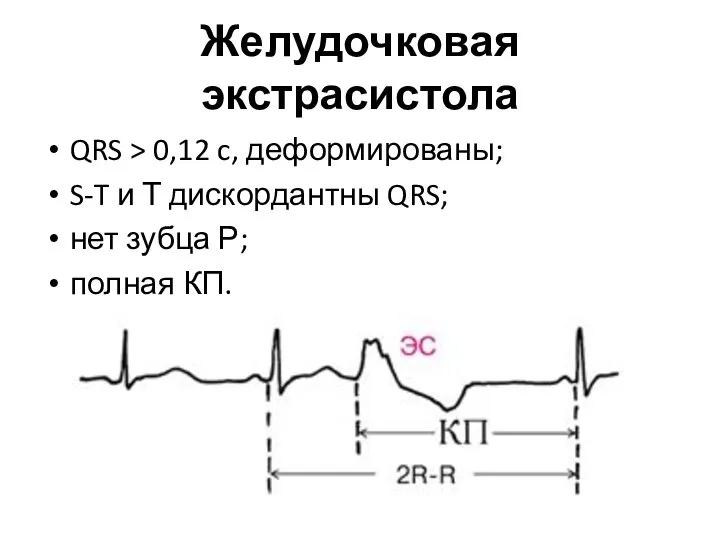 Желудочковая экстрасистола QRS > 0,12 c, деформированы; S-T и Т дискордантны