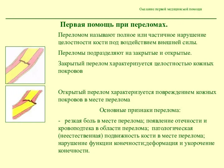 Оказание первой медицинской помощи Первая помощь при переломах. Переломом называют полное