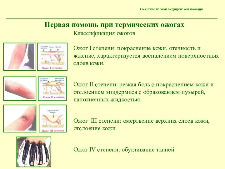 Оказание первой медицинской помощи Первая помощь при термических ожогах Классификация ожогов