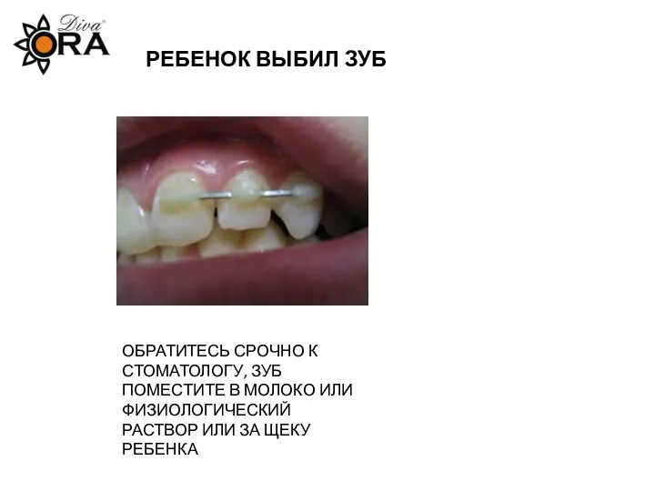 РЕБЕНОК ВЫБИЛ ЗУБ ОБРАТИТЕСЬ СРОЧНО К СТОМАТОЛОГУ, ЗУБ ПОМЕСТИТЕ В МОЛОКО
