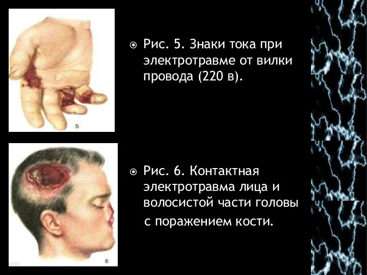 Рис. 5. Знаки тока при электротравме от вилки провода (220 в).