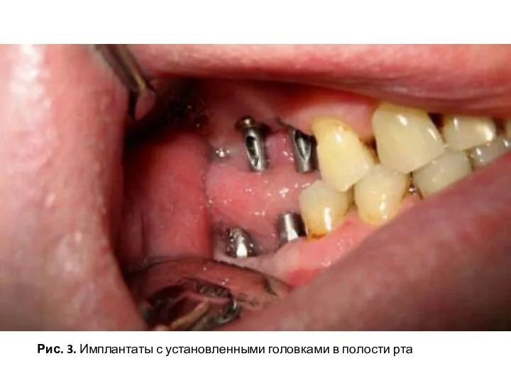 Рис. 3. Имплантаты с установленными головками в полости рта