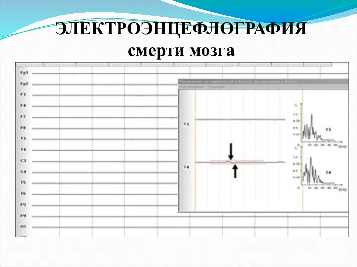 ЭЛЕКТРОЭНЦЕФЛОГРАФИЯ смерти мозга