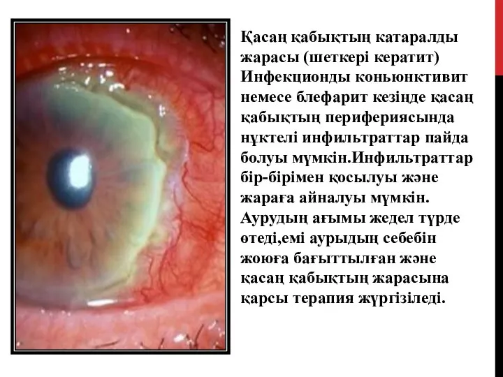 Қасаң қабықтың катаралды жарасы (шеткері кератит) Инфекционды коньюнктивит немесе блефарит кезіңде