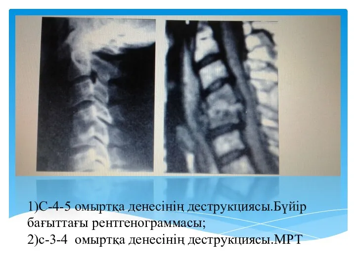 1)С-4-5 омыртқа денесінің деструкциясы.Бүйір бағыттағы рентгенограммасы; 2)с-3-4 омыртқа денесінің деструкциясы.МРТ