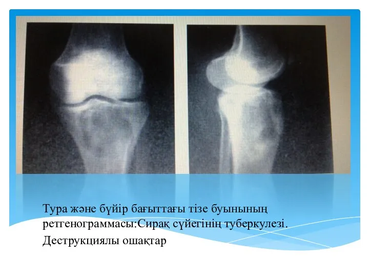 Тура және бүйір бағыттағы тізе буынының ретгенограммасы:Сирақ сүйегінің туберкулезі.Деструкциялы ошақтар.