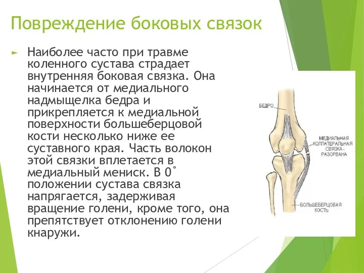 Повреждение боковых связок Наиболее часто при травме коленного сустава страдает внутренняя