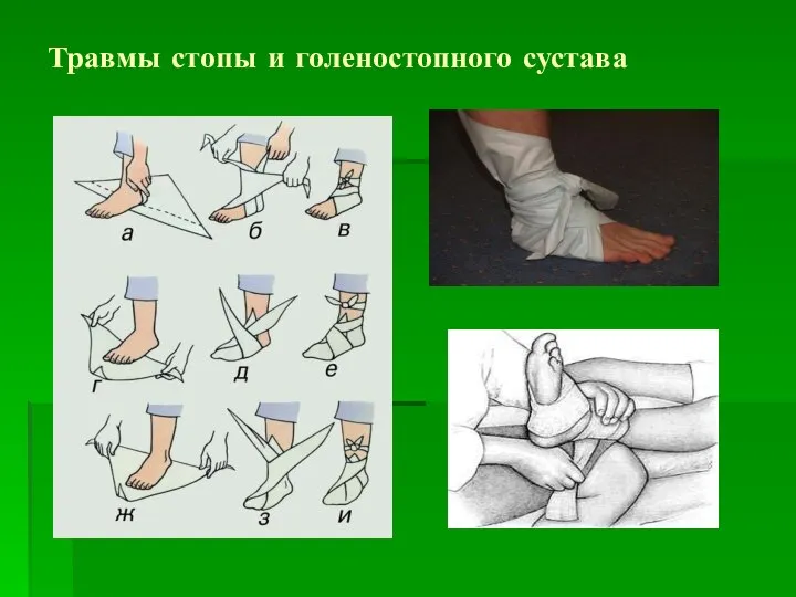 Травмы стопы и голеностопного сустава