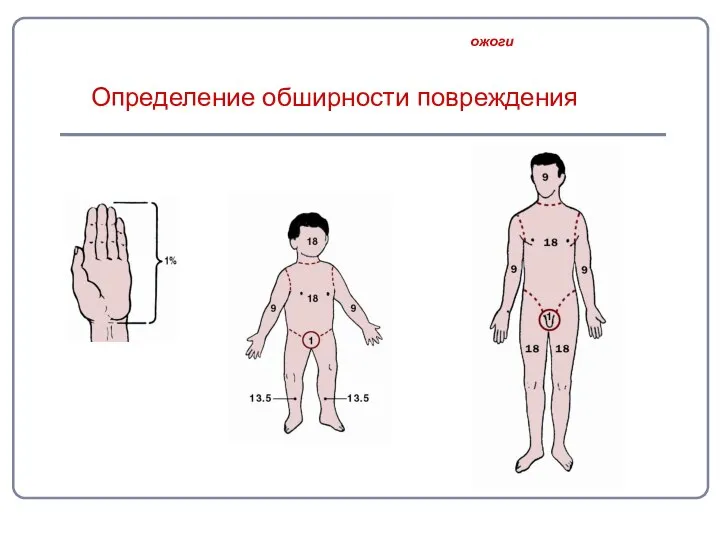 Определение обширности повреждения