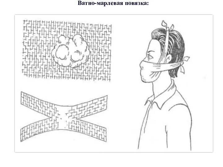 Ватно-марлевая повязка: