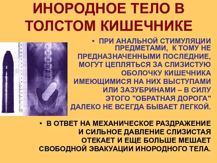 ИНОРОДНОЕ ТЕЛО В ТОЛСТОМ КИШЕЧНИКЕ ПРИ АНАЛЬНОЙ СТИМУЛЯЦИИ ПРЕДМЕТАМИ, К ТОМУ