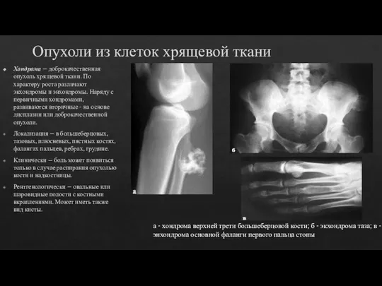 Опухоли из клеток хрящевой ткани Хондрома – доброкачественная опухоль хрящевой ткани.