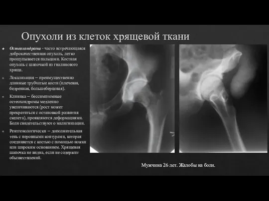 Опухоли из клеток хрящевой ткани Остеохондрома - часто встречающаяся доброкачественная опухоль,