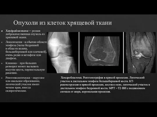 Опухоли из клеток хрящевой ткани Хондробластома – редкая доброкачественная опухоль из