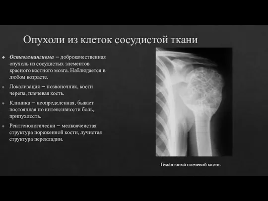 Опухоли из клеток сосудистой ткани Остеогемангиома – доброкачественная опухоль из сосудистых